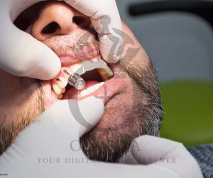 Dentist Applying Temporary Implanted Dentures